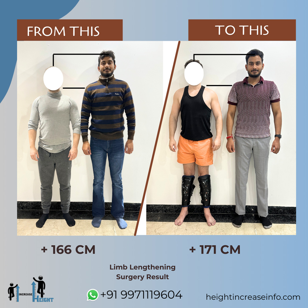 Height Increase Info | Limb Lengthening Surgery