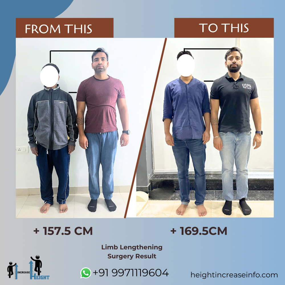 Height Increase Info | Limb Lengthening Surgery