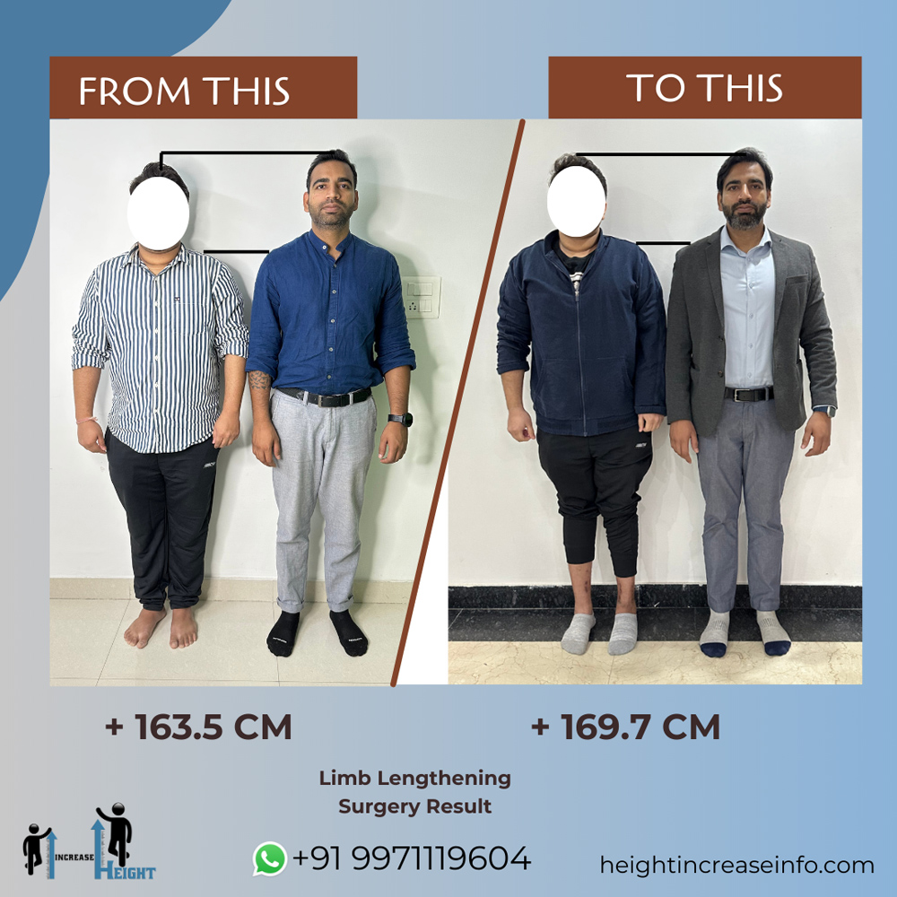 Height Increase Info | Limb Lengthening Surgery