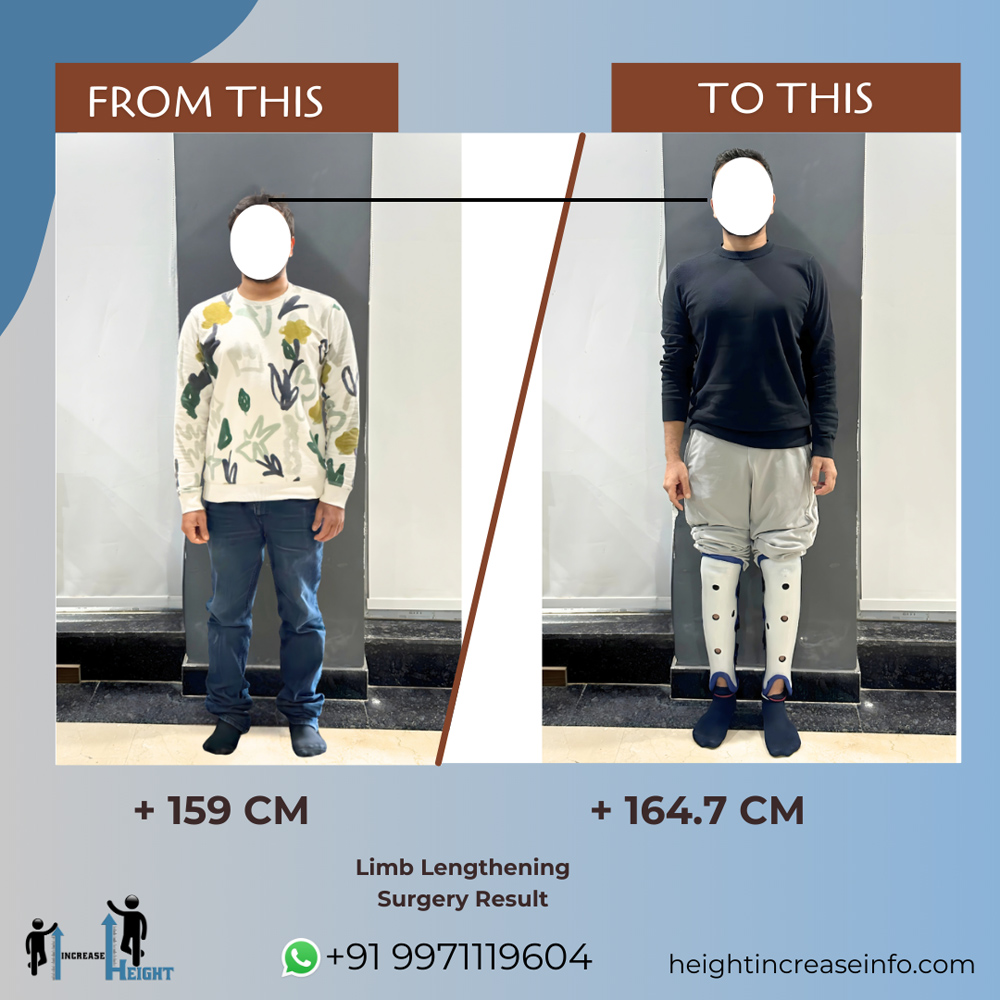 Height Increase Info | Limb Lengthening Surgery