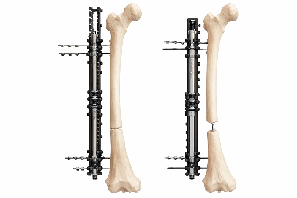 Height Increase Surgery Procedure